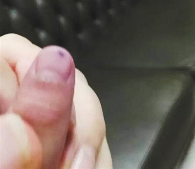 多名儿童疑遭教师针扎.jpg